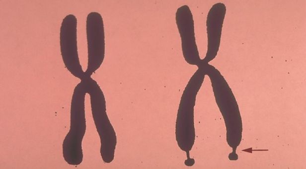 08_26-fragile_x_syndrome